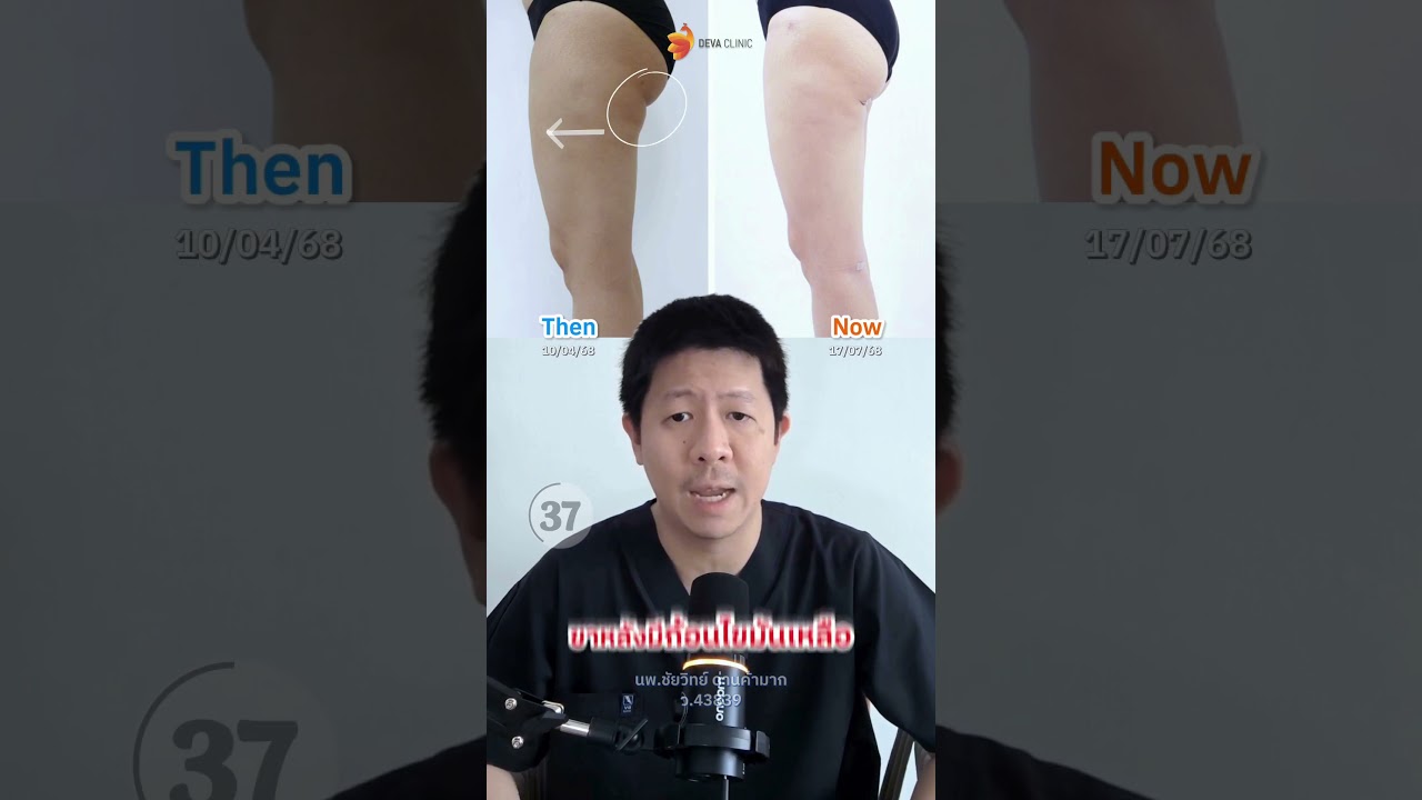 🛑 ความเสี่ยงถ้าไม่ดูดต้นขาแบบ 360 องศา ดูดแค่บางจุด ... ระวังไม่จบ !!