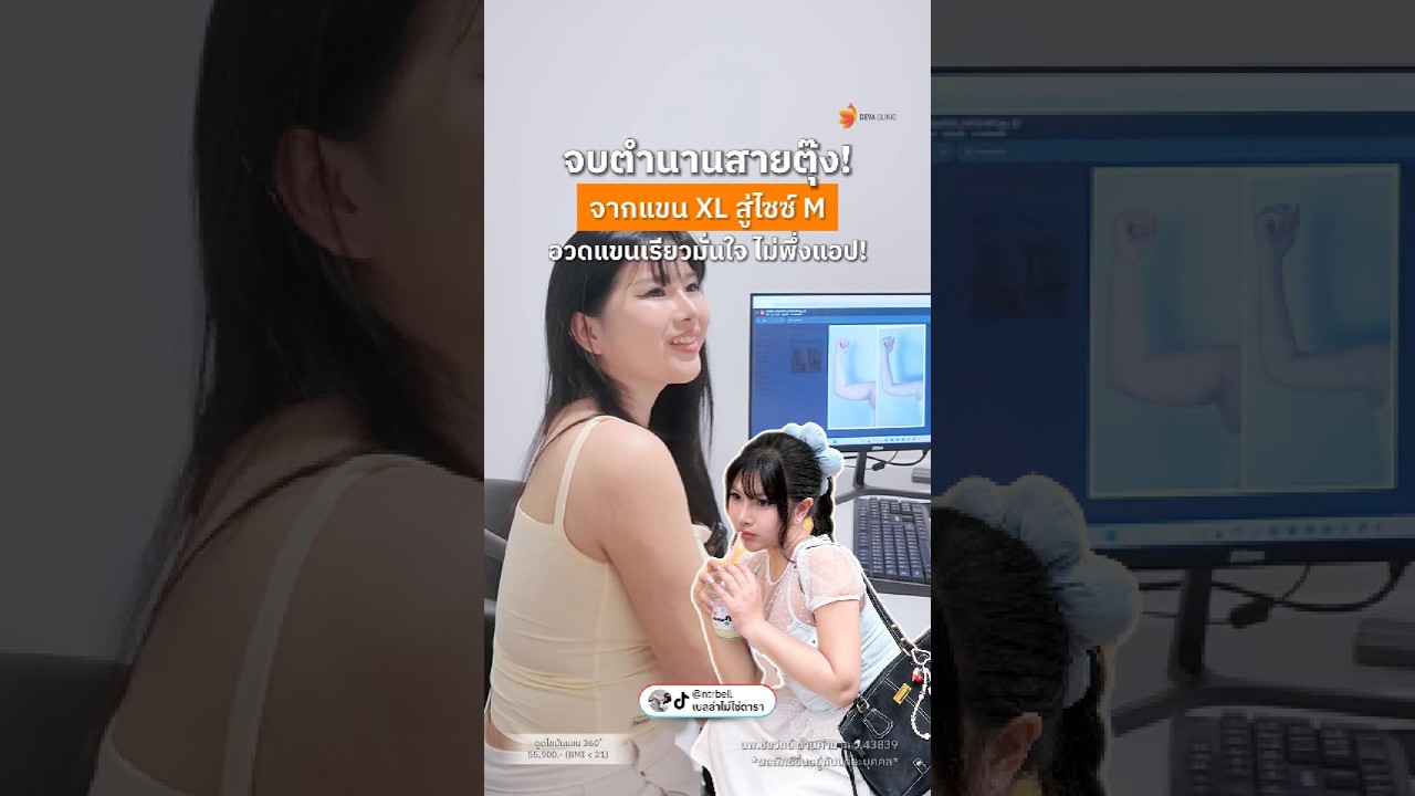 เปลี่ยนแขน XL เป็น M แบบสัดส่วนสมดุล เก็บหมดทั้งท้องแขน หน้าแขน และหัวไหล่ ไม่มีแผลเป็นโป๊ะ