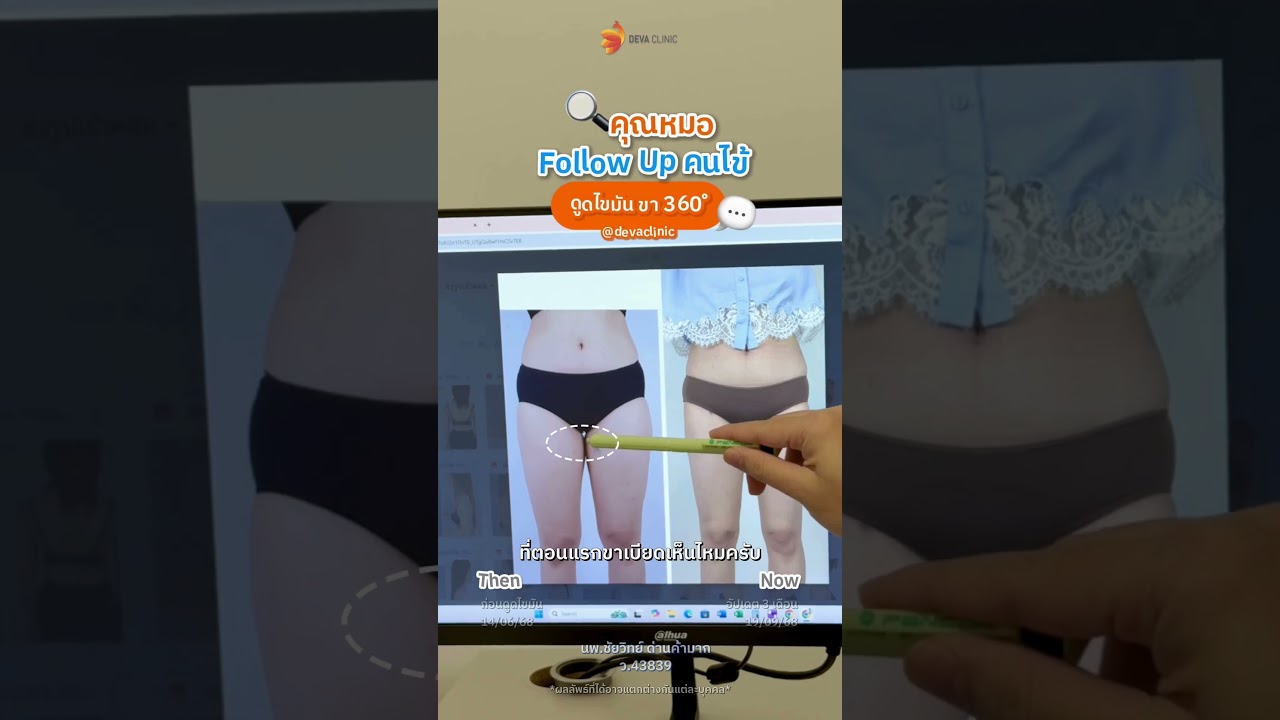 คุณหมอขอรีวิว คุณมนต์ ขา 360 องศา 3 เดือน