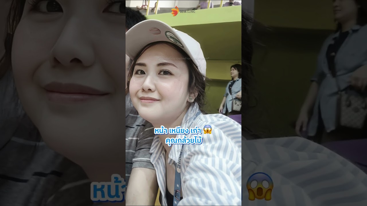 รวมรีวิวดูดไขมันเหนียง กรอบหน้า ลองมาทุกอย่าง เหนียงไม่ลด