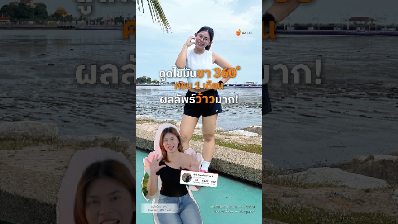 🌟 "1,000 เต็ม 100 ไปเลย! ขาใหม่คู่ควรและคุ้มค่ามากจริงๆ" 🌟กับโปรแกรม ดูดไขมันขา 360°