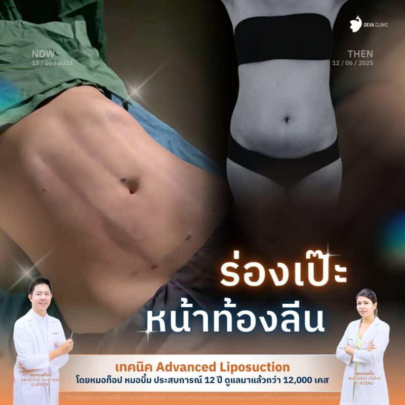 ร่องชัด ดูดไขมันร่อง 11