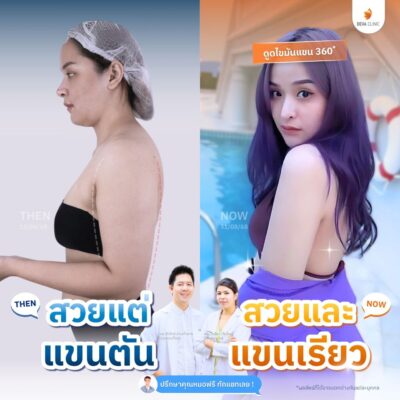 รวมรีวิวดูดแขน 1