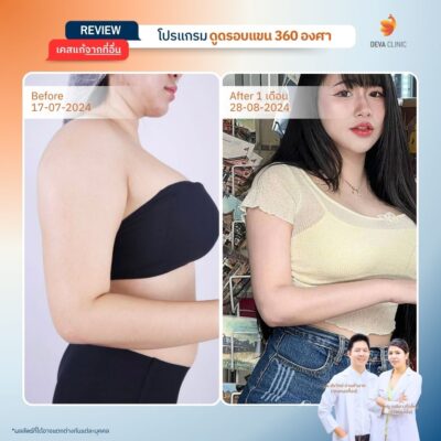 รีวิวดูดไขมันต้นแขน เคสแก้ 8