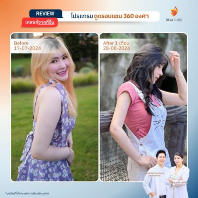 รีวิวเคสจริงดูดไขมันต้นแขน 2