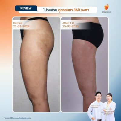 รีวิวต้นขาทางการแพทย์ 6