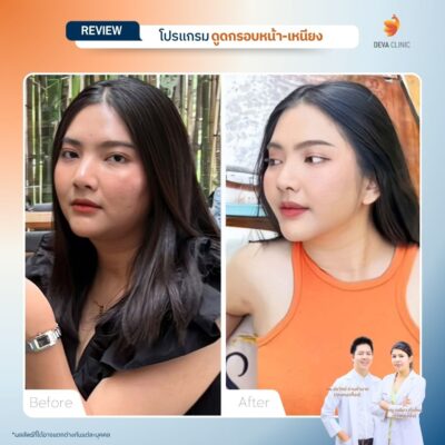 รีวิวดูดเหนียง หน้าบริการ 12