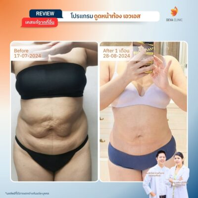 รีวิวเคสจริงดูดไขมันหน้าท้อง 1