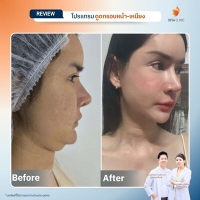 รีวิวดูดเหนียง หน้าบริการ 11