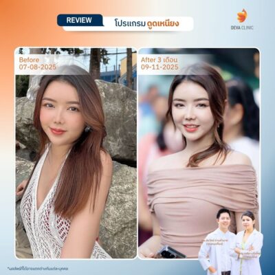 รีวิวเคสจริงดูดไขมันหน้า 4