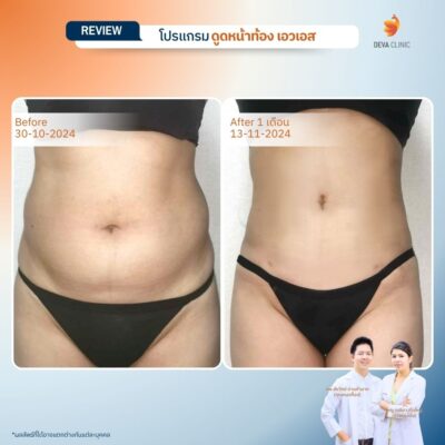 รีวิวทางการแพทย์ท้อง 11