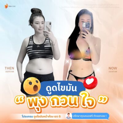 รีวิวดูดไขมันหน้าท้องผู้ใช้จริง 3