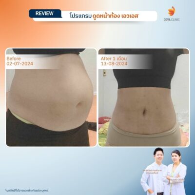 รีวิวทางการแพทย์ท้อง 3