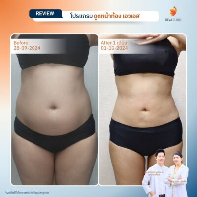 รีวิวทางการแพทย์ท้อง 4