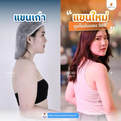 รวมรีวิวดูดแขน 4