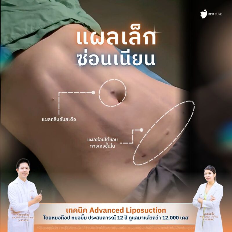 ซ่อนแผล ดูดไขมันร่อง 11