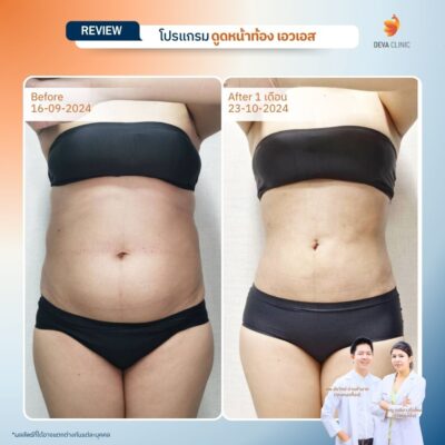 รีวิวทางการแพทย์ท้อง 16