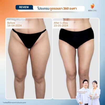 รีวิวต้นขาทางการแพทย์ 3