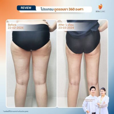 รีวิวต้นขาทางการแพทย์ 9