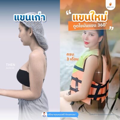 รวมรีวิวดูดแขน 3