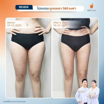 รีวิวต้นขาทางการแพทย์ 8