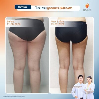 รีวิวต้นขาทางการแพทย์ 5