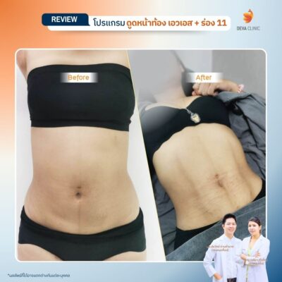 รีวิวดูดไขมันร่อง 11 13