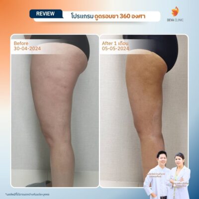 รีวิวต้นขาทางการแพทย์ 11