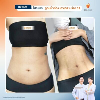 รีวิวดูดไขมันร่อง 11 14