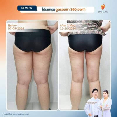 รีวิวต้นขาทางการแพทย์ 13