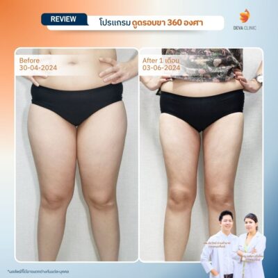 รีวิวต้นขาทางการแพทย์ 10