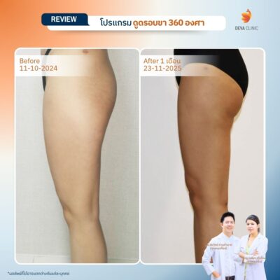 รีวิวต้นขาทางการแพทย์ 14