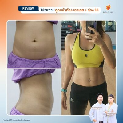 รีวิวดูดไขมันร่อง 11 4