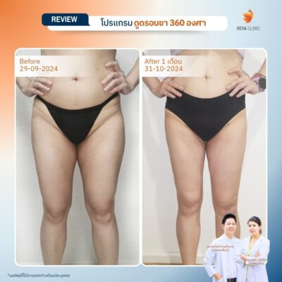 รีวิวต้นขาทางการแพทย์ 12