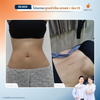 รีวิวดูดไขมันร่อง 11 10