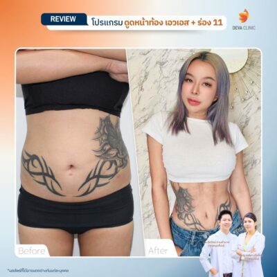 รีวิวดูดไขมันร่อง 11 15
