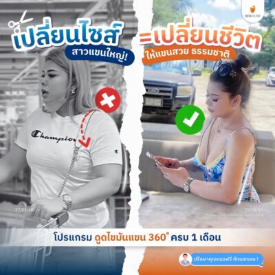 รวมรีวิวดูดแขน คลินิกดูดไขมัน 2