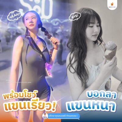 รวมรีวิวดูดแขน คลินิกดูดไขมัน 4