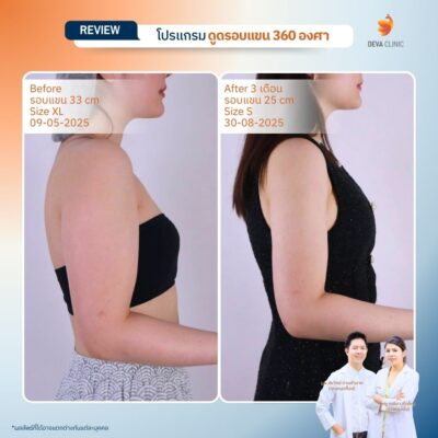Before & After ต้นแขน 8
