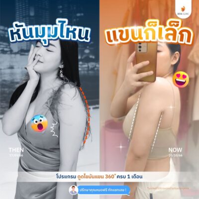 รวมรีวิวดูดแขน คลินิกดูดไขมัน 5