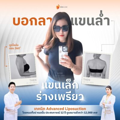 รวมรีวิวดูดแขน คลินิกดูดไขมัน 10