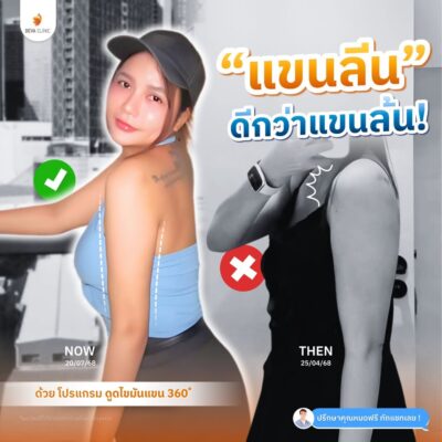 รวมรีวิวดูดแขน คลินิกดูดไขมัน 11