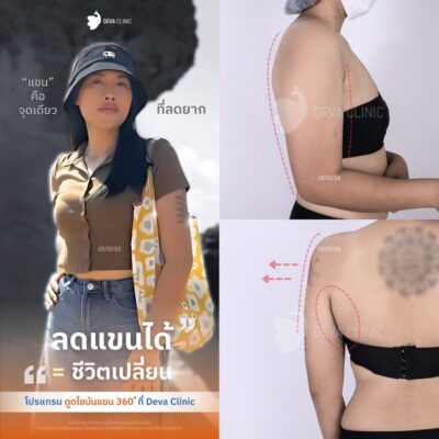 รวมรีวิวดูดแขน คลินิกดูดไขมัน 12