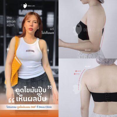 รวมรีวิวดูดแขน คลินิกดูดไขมัน 13