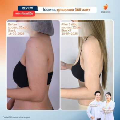 Before & After ต้นแขน 16