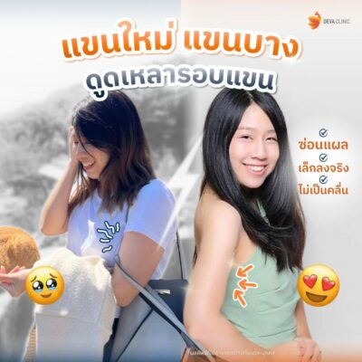 รวมรีวิวดูดแขน คลินิกดูดไขมัน 1