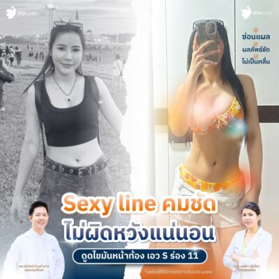 รีวิวดูดไขมันหน้าท้อง คลินิกดูดไขมัน 1