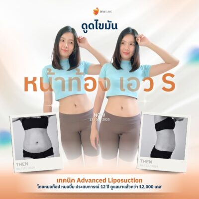 รีวิวดูดไขมันหน้าท้อง คลินิกดูดไขมัน 3