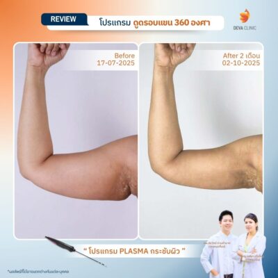 รีวิวแขนย้วย หลังดูดไขมันแขน กระชับผิว jplasma 2