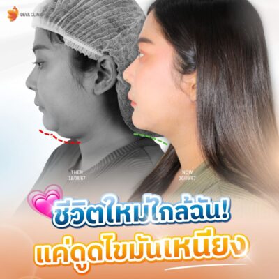 รีวิวดูดไขมันเหรียง คลินิกดูดไขมัน 1